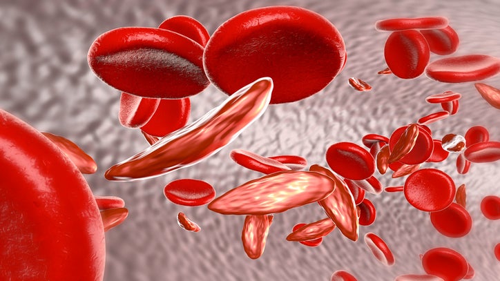 Facts About Sickle Cell Disease - Essence